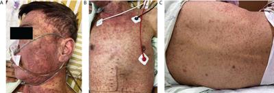 Diagnostic and therapeutic dilemma in Stevens–Johnson syndrome-like acute graft-versus-host disease after liver transplantation: A case report